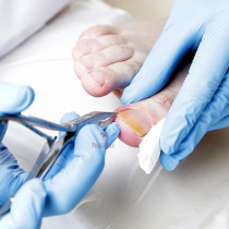 L' ongle incarné et ses stades.