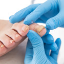 Nail fungus