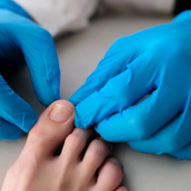 Comment choisir les bons produits pour traiter les mycoses des pieds ?