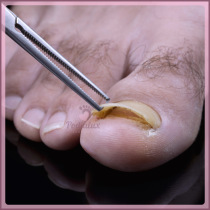 Targeted onychoplasty: The different methods.